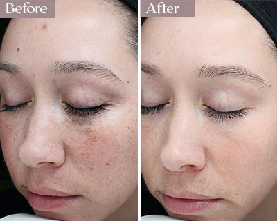 vi peel before after nyc